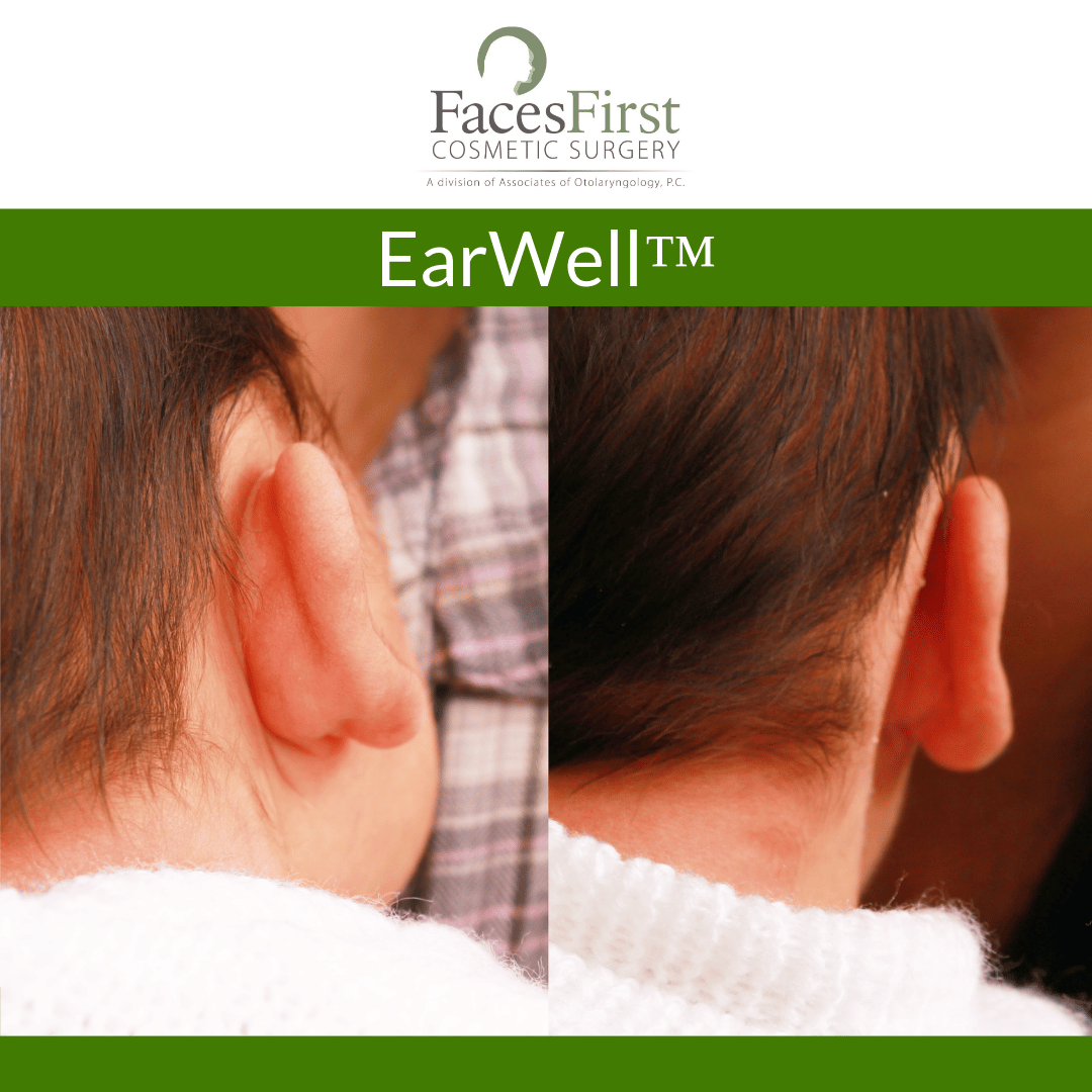 EarWell Infant Ear Correction Denver