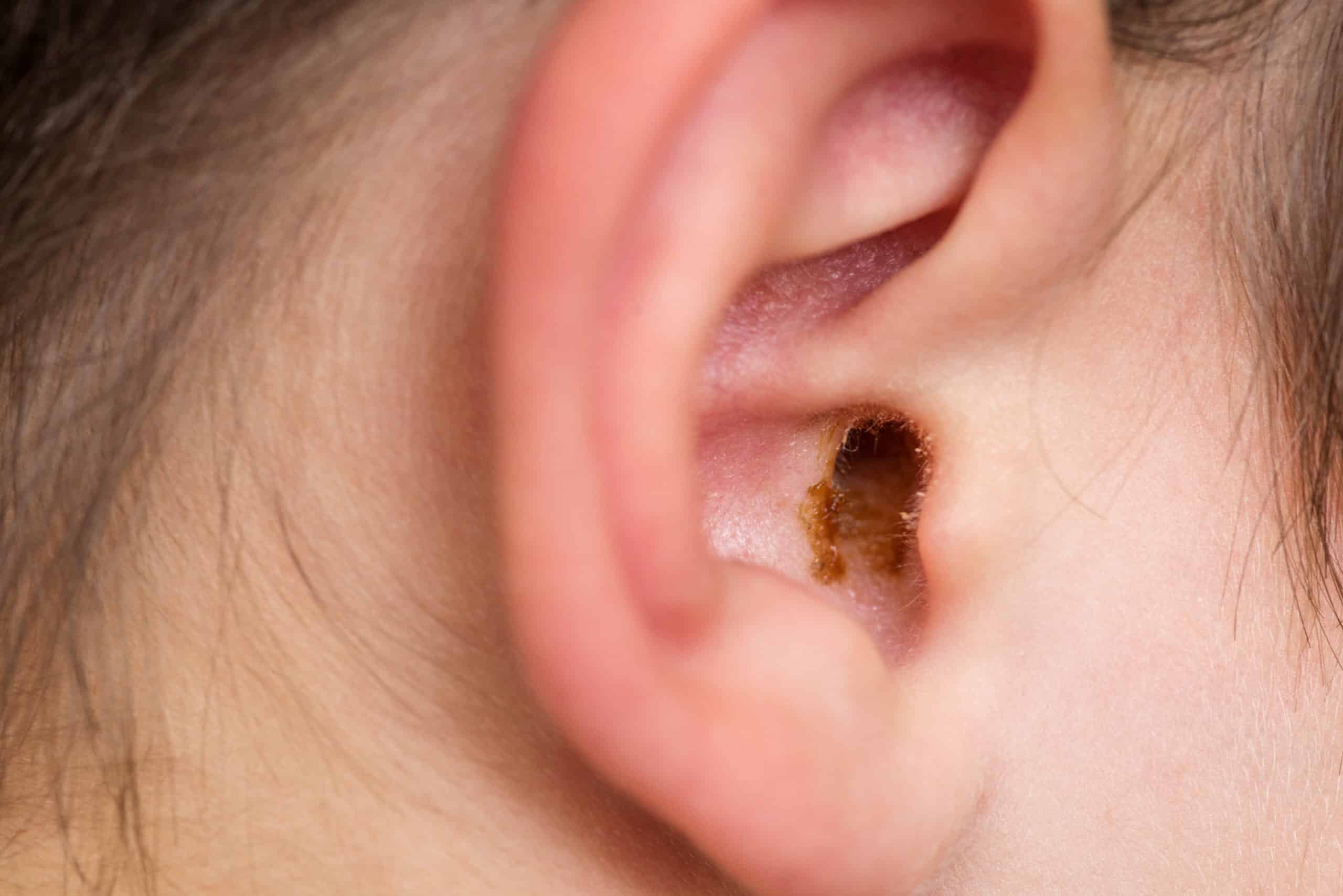 Earwax,In,The,Dirty,Ear,Of,A,Child.,Hole,Ear