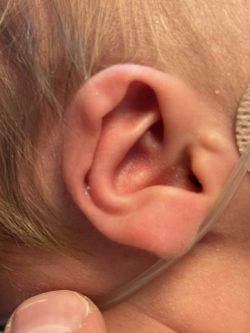 EarWell Before