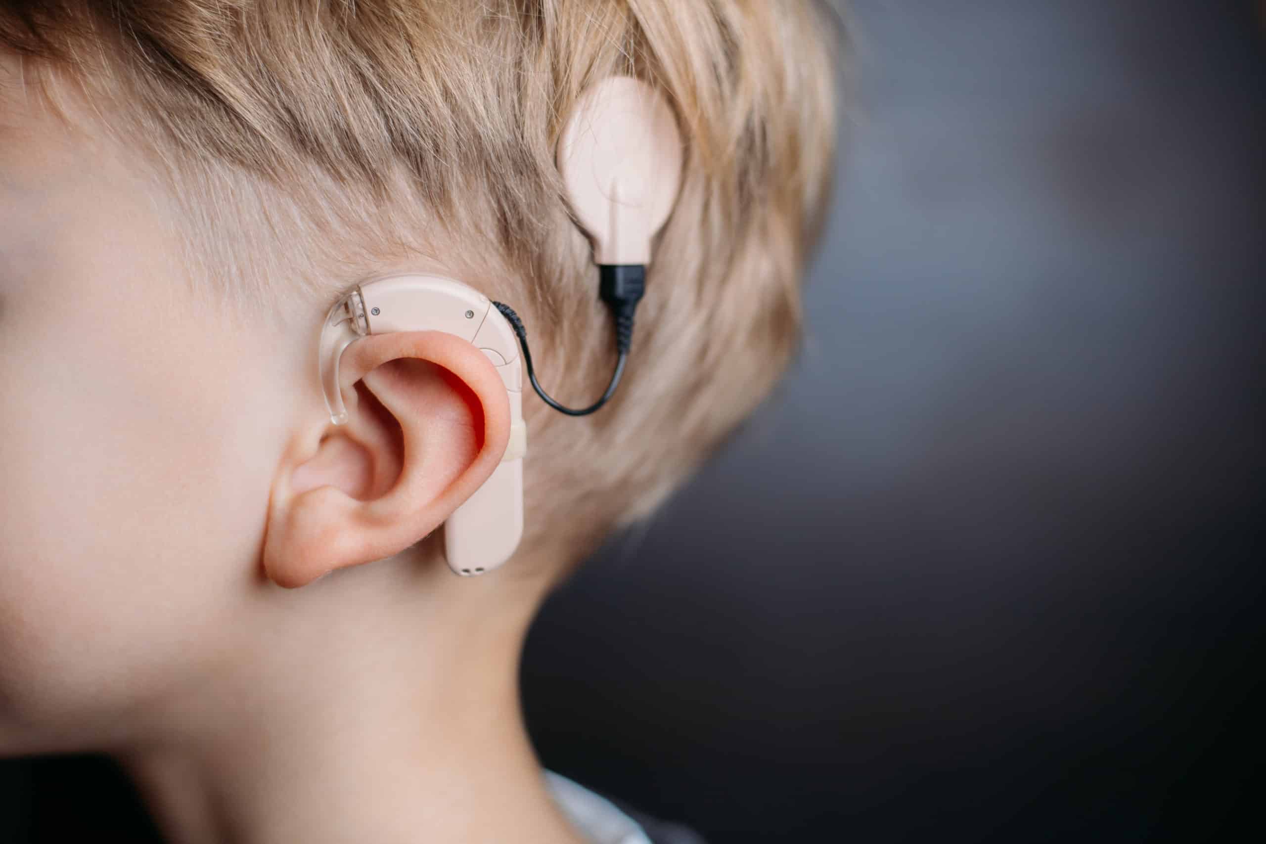 Benefits of Cochlear Implants