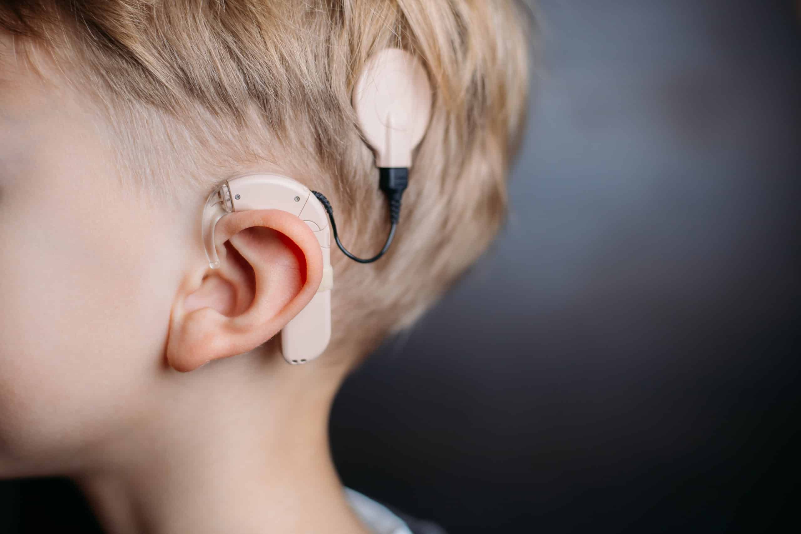 Cochlear,Implant,On,The,Boy’s,Head.,Hearing,Aide